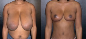 breast-implants05a