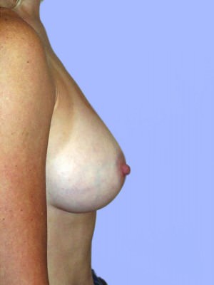 Breast Surgery