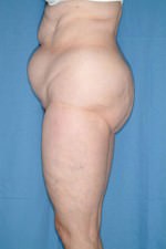 Tummy Tuck/Abdominoplasty