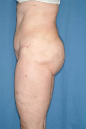 Tummy Tuck/Abdominoplasty