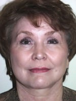Face Lift and Neck Lift/Rhytidectomy