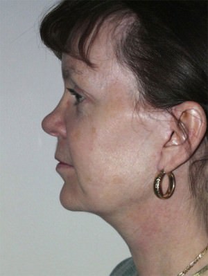 Face Lift and Neck Lift/Rhytidectomy