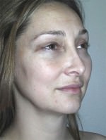 Nose Surgery/Rhinoplasty