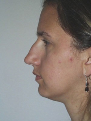 Nose Surgery/Rhinoplasty