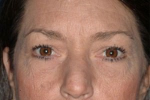 Eyelid Surgery/Blepharoplasty