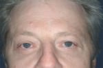 Eyelid Surgery/Blepharoplasty