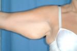 Arm Lift/Brachioplasty