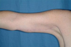 Arm Lift/Brachioplasty