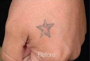 Tattoo Removal with PiQo4