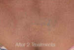 Tattoo Removal with PiQo4