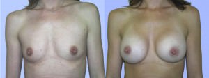 breast-implant-14