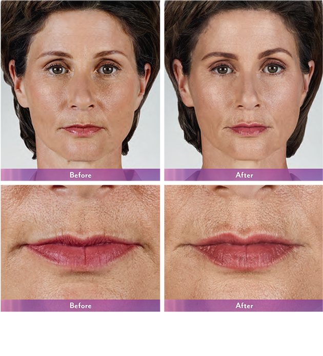 Juvederm Volbella Before and After Pictures