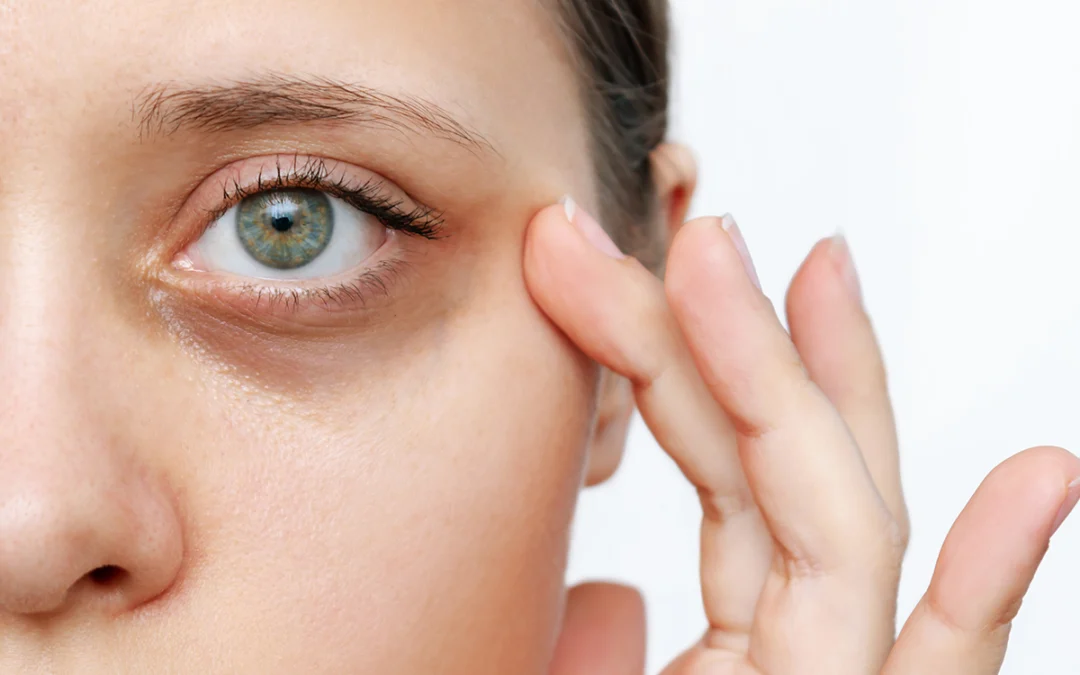 How to Get Rid of Dark Under Eye Circles