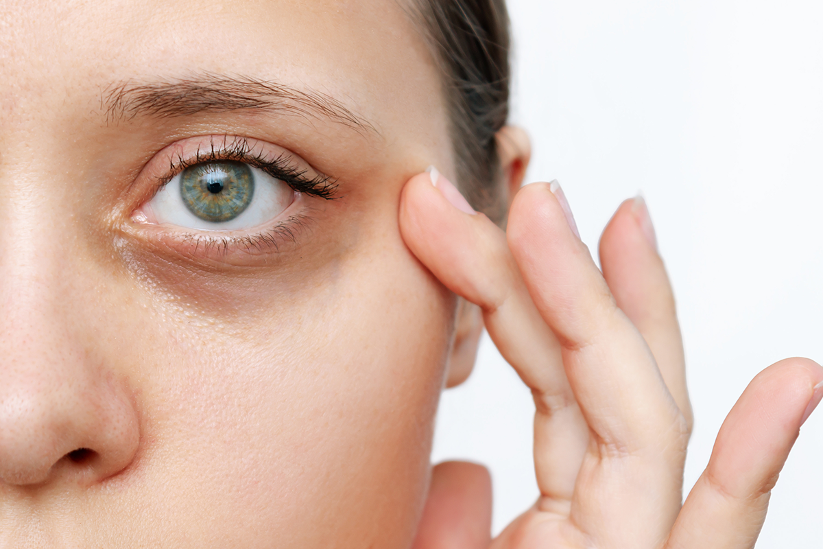 A young Caucasian woman demonstrating dark circles under her eyes with hand