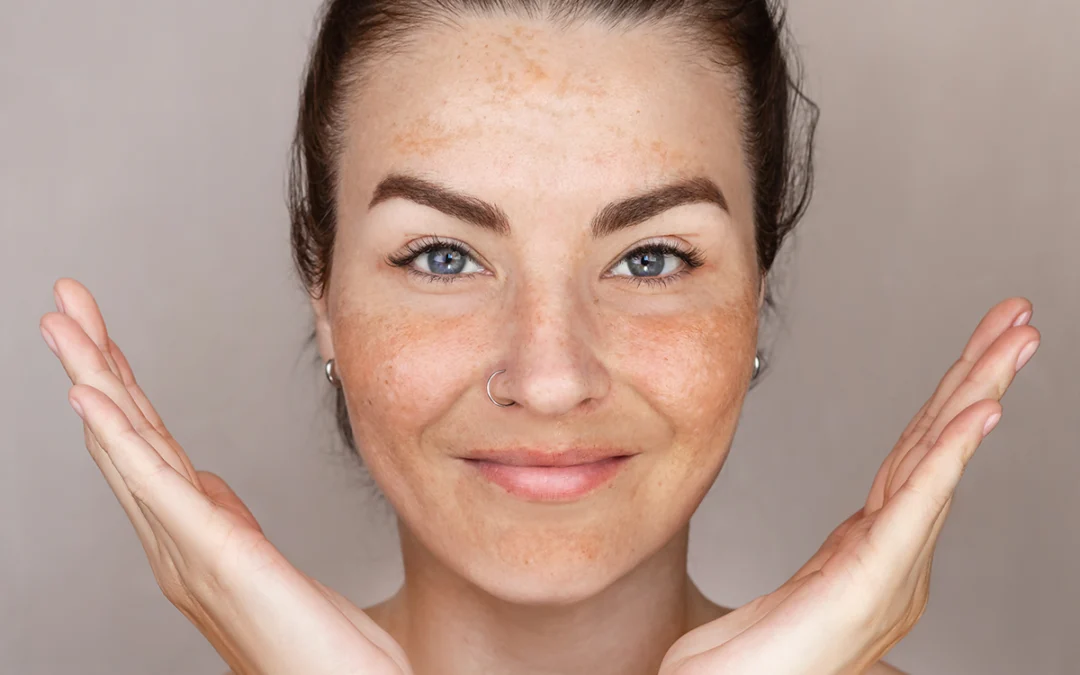 Laser Skin Tightening – SkinTyte Treatments Plano