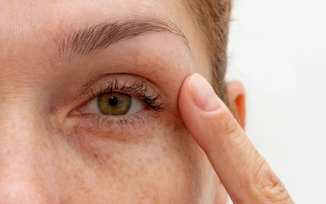 Improve the Look of Your Eyes with Eyelid Surgery
