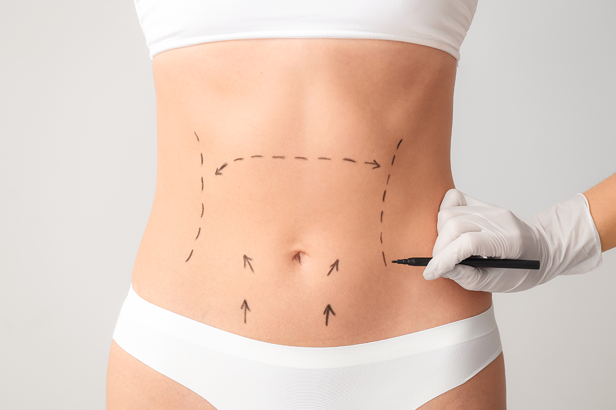 Plastic surgeon applying marks on female body