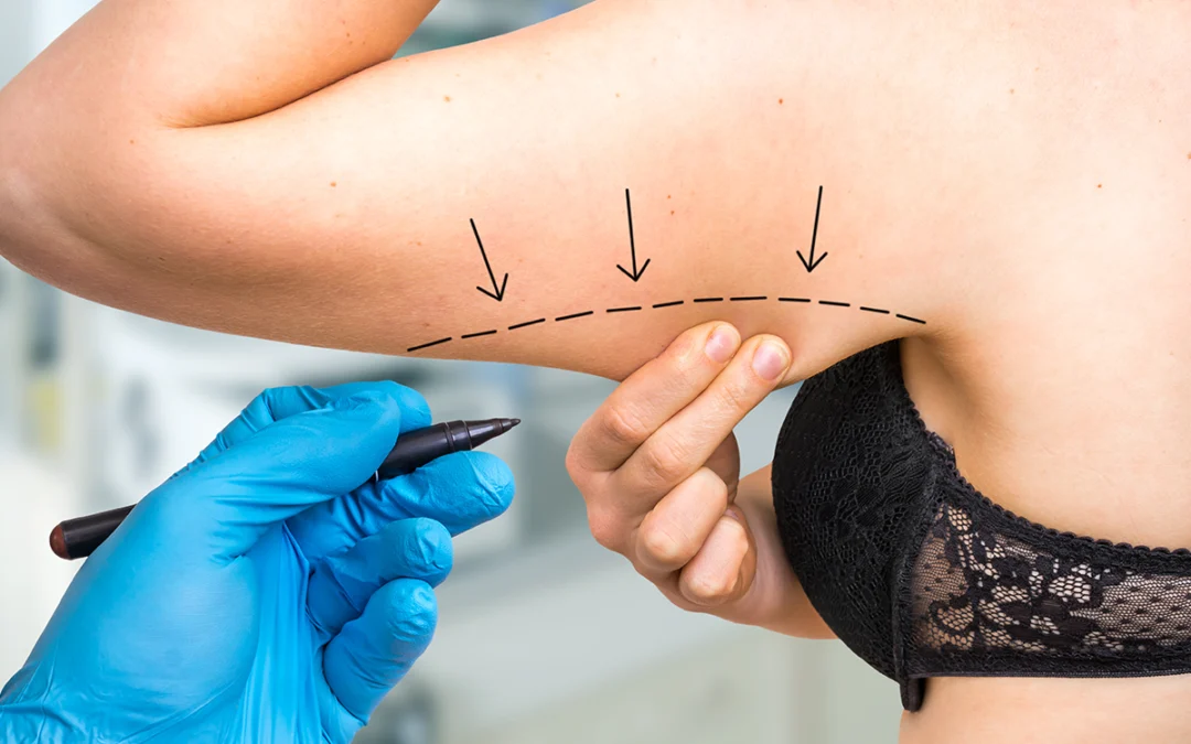 Get More Defined Arms with an Arm Lift Surgery