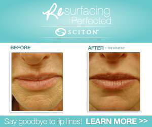 Sciton laser resurfacing before and after photo