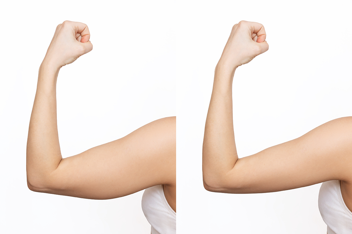 Two shots of a young woman with excess fat on her arm and toned arm before and after losing weight