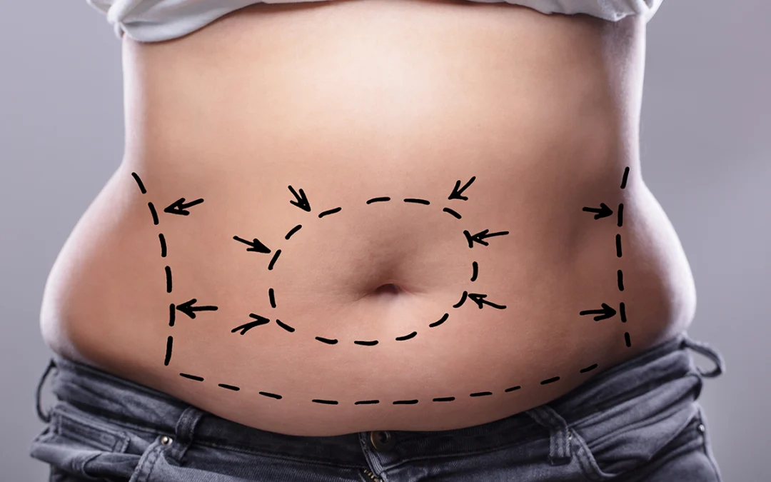 Tummy Tuck Plano