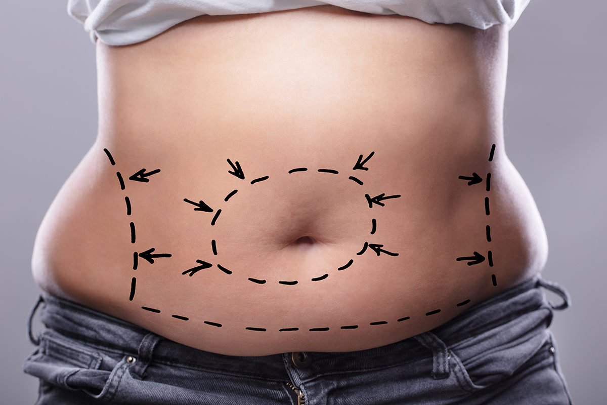 Woman's belly with pre-surgery drawing arrows and lines