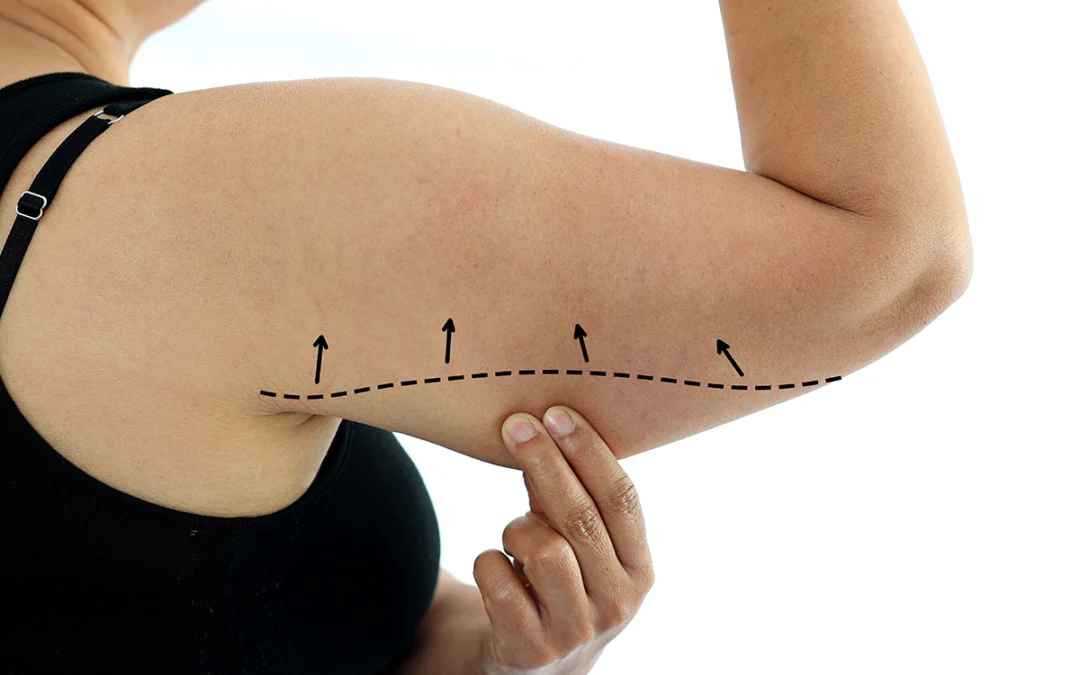 Get Beautiful-Looking Arms with an Arm Lift