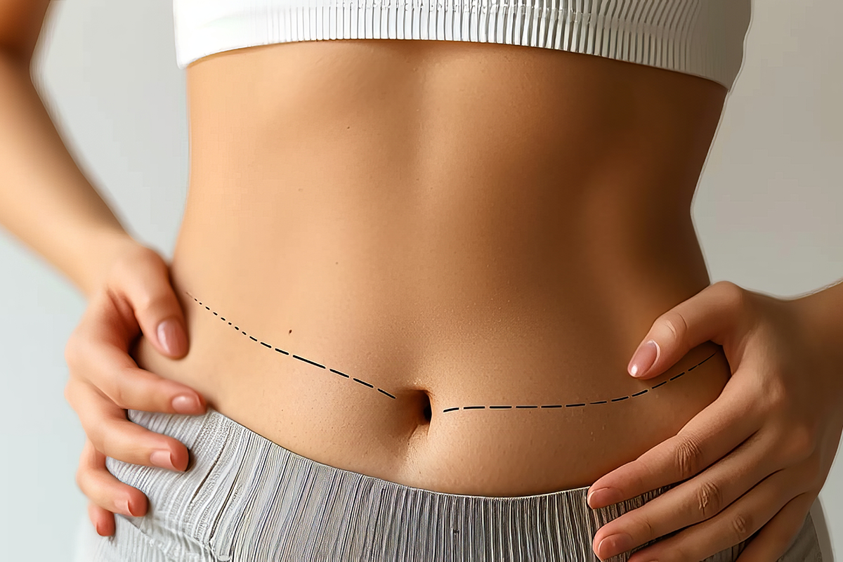 Woman with flat belly, dashed lines before abdominoplasty
