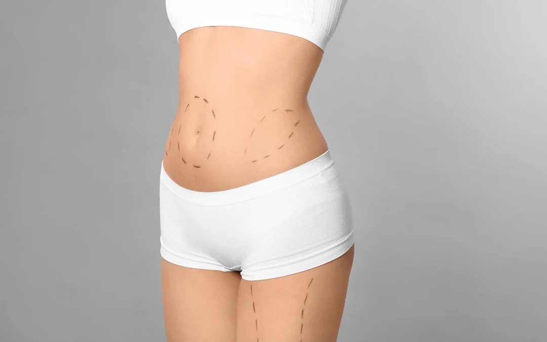 Get a Head Start on Your New Year’s Resolution with a Liposuction